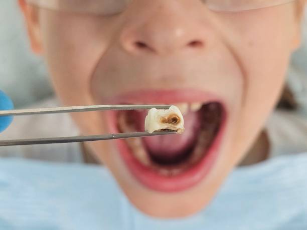 Best Emergency Tooth Extraction in Henning, TN